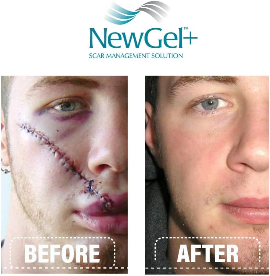 NGO-810 NEWGEL+E ADVANCED SILICONE GEL FOR SCARS - 1 OZ./30G