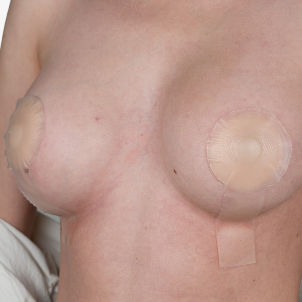 NG-324 NEWGEL+ LOLLYPOPS FOR BREAST SCARS - CLEAR