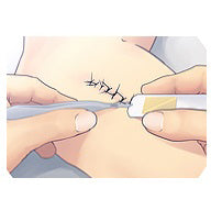 85-4332 SutureOut - Suture Removal Kit 50EA/CA
