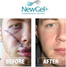 NGO-810 NEWGEL+E ADVANCED SILICONE GEL FOR SCARS - 1 OZ./30G