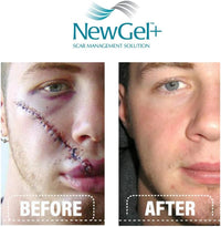 NGO-810 NEWGEL+E ADVANCED SILICONE GEL FOR SCARS - 1 OZ./30G